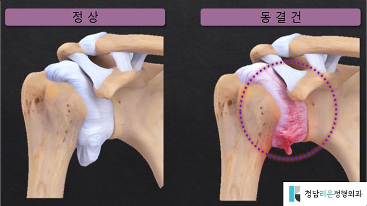  오십견 수술비용? 그전에 이것부터 확인하셔야 합니다.