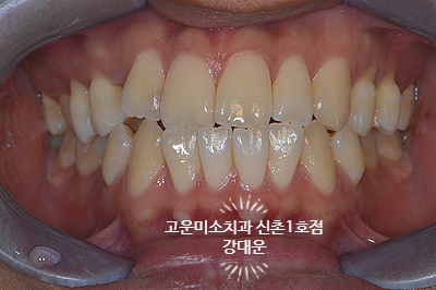  [성인교정] 결손치, 돌출, 비대칭, 유치 /송곳니가 없어요