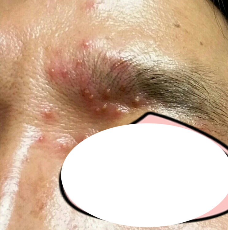  벌레물린곳 연고대신 대처하는 방법