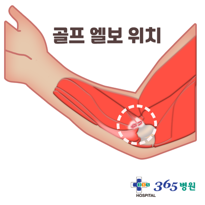  [창원마산 척추관절 디스크 365병원] 골프 엘보