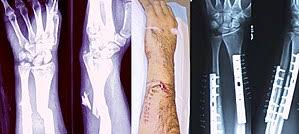 간호진단케이스 사지골절 개방성골절 원인증상치료 응급처치 쇼크합병증 간호학과 간호진단케이스 사지골절 개방성골절 원인증상치료 응급처치 쇼크합병증 간호학과