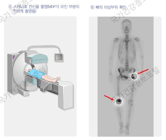 암 검사정보 - 뼈 스캔(Bone Scan)