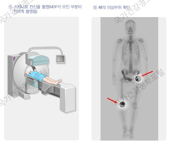  암 검사정보 - 뼈 스캔(Bone Scan)