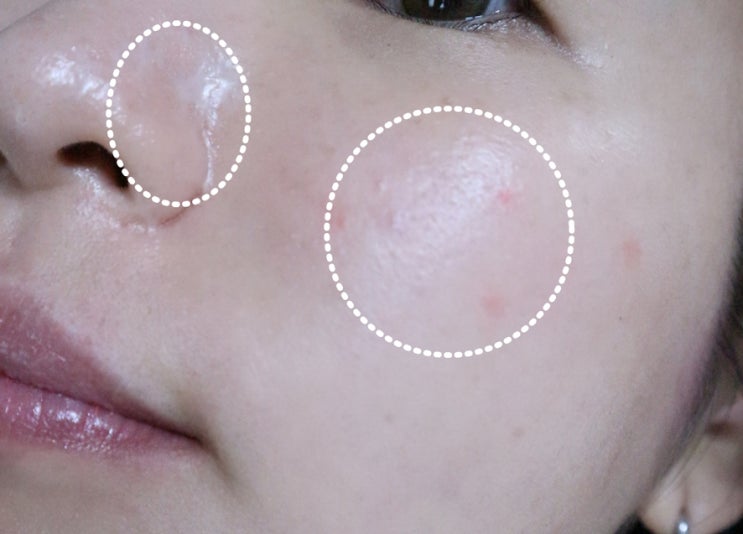 안짜지는 딱딱한 아픈 여드름 뾰루지 여러가지 케어법 안짜지는 딱딱한 아픈 여드름 뾰루지 여러가지 케어법