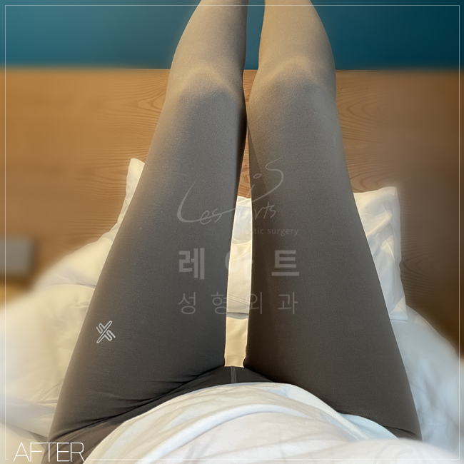  레아트성형외과의원 탄력 좋은 체형, 허벅지지방흡입 후기 셀카