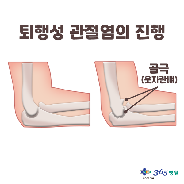  [창원마산 척추관절 디스크 365병원] 팔꿈치 관절염