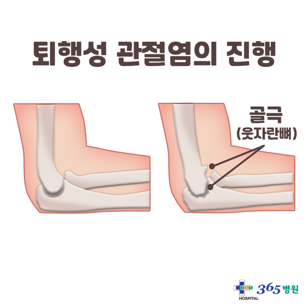 [창원마산 척추관절 디스크 365병원] 팔꿈치 관절염