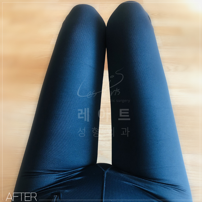  뼈벅지/일자라인 레아트 허벅지지방흡입