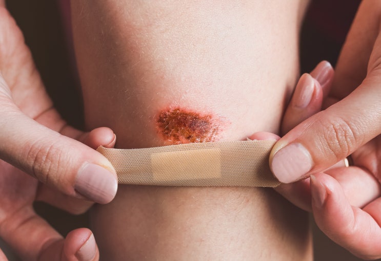  [115강] 영어회화표현 다쳤을 때 붙이는 반창고(Band-aid)를 영국에서는 뭐라고 할까? I British English 배우기