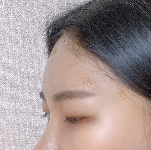 강남역 이마필러후기 6cc ( 미간붓기 / 통증 / 유지기간 / 관자필러 / 이마필러잘하는곳 / 1일~7일차 / 정보공유 ) 10