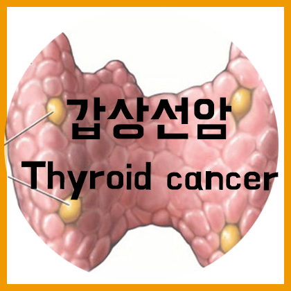  [목] 갑상선암(Thyroid cancer)