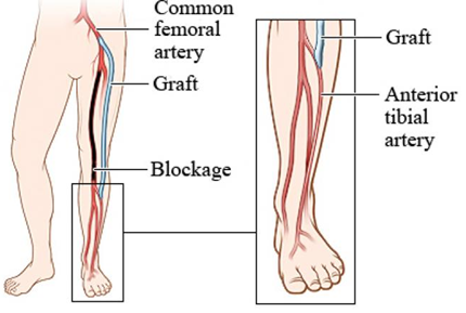  Vascular Bypass operation