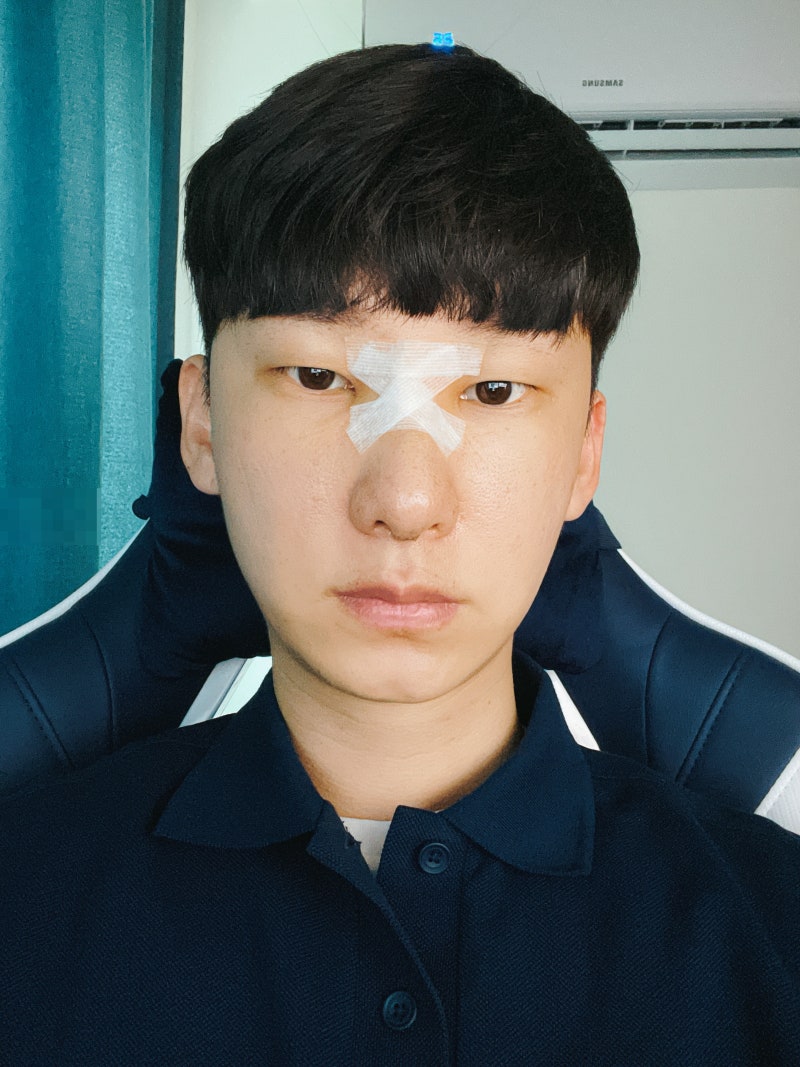 비중격 만곡증 수술 후기(비밸브재건술 비염 코성형 포함) 2탄