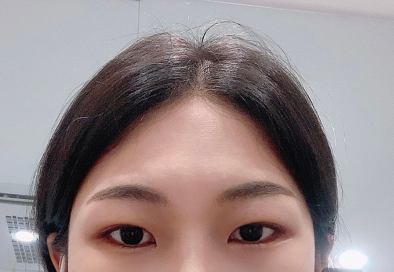 강남역 이마필러후기 6cc ( 미간붓기 / 통증 / 유지기간 / 관자필러 / 이마필러잘하는곳 / 1일~7일차 / 정보공유 ) 2