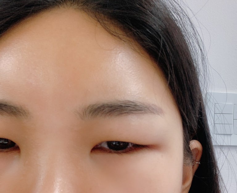 강남역 이마필러후기 6cc ( 미간붓기 / 통증 / 유지기간 / 관자필러 / 이마필러잘하는곳 / 1일~7일차 / 정보공유 ) 7