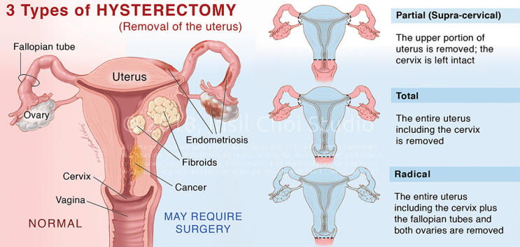  일산 차병원 입원 후기: 1. 자궁절제술 hysterectomy