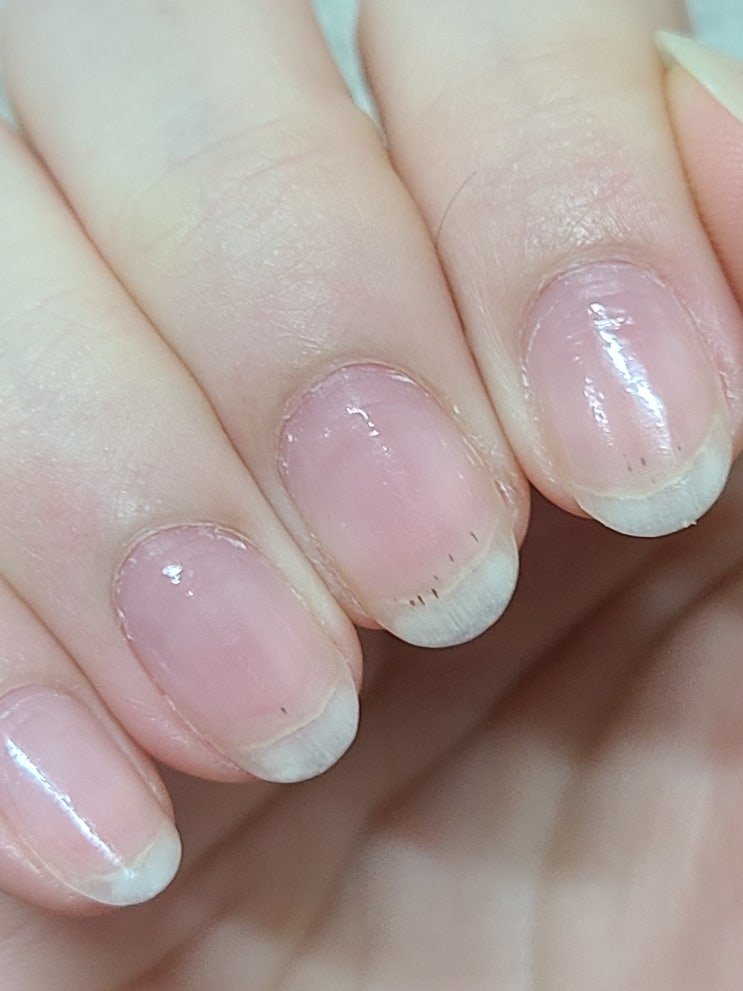  네일아트 후 손톱 까만점 / 젤네일 쏙오프 제거 후 손톱 손상
