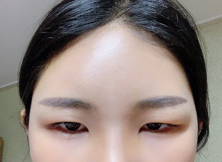 강남역 이마필러후기 6cc ( 미간붓기 / 통증 / 유지기간 / 관자필러 / 이마필러잘하는곳 / 1일~7일차 / 정보공유 ) 3