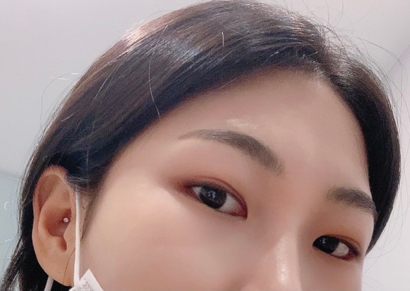 강남역 이마필러후기 6cc ( 미간붓기 / 통증 / 유지기간 / 관자필러 / 이마필러잘하는곳 / 1일~7일차 / 정보공유 ) 5