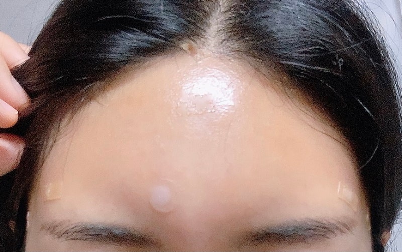 강남역 이마필러후기 6cc ( 미간붓기 / 통증 / 유지기간 / 관자필러 / 이마필러잘하는곳 / 1일~7일차 / 정보공유 ) 9