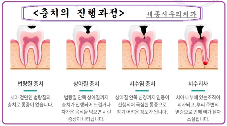  충치의 진행단계별 치료방법을 알아볼까요?