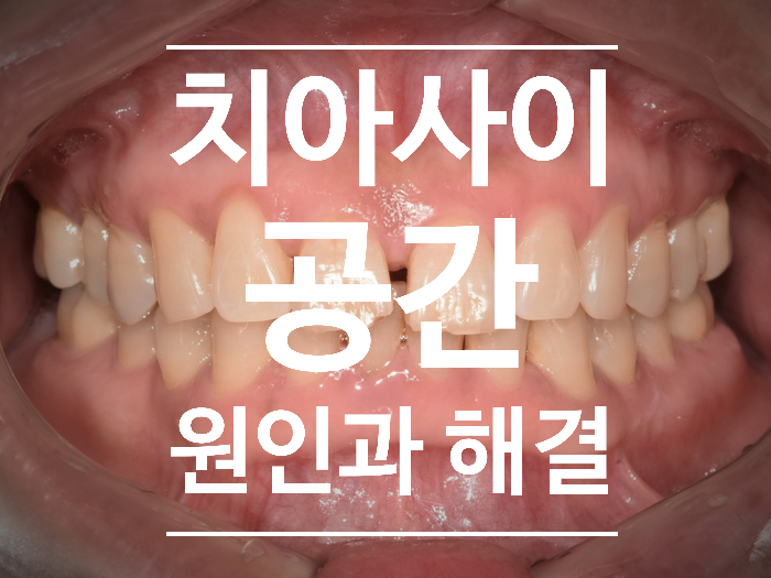 미사, 양평, 여주 교정치과 / 과개교합 & 치아 사이 공간 교정 케이스 & 교정치료 나이에 관한 이야기 미사, 양평, 여주 교정치과 / 과개교합 & 치아 사이 공간 교정 케이스 & 교정치료 나이에 관한 이야기