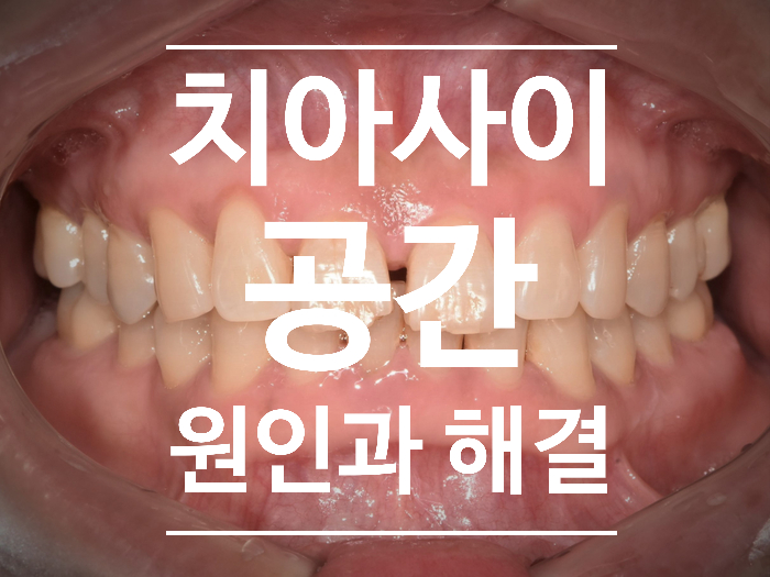 미사, 양평, 여주 교정치과 / 과개교합 & 치아 사이 공간 교정 케이스 & 교정치료 나이에 관한 이야기