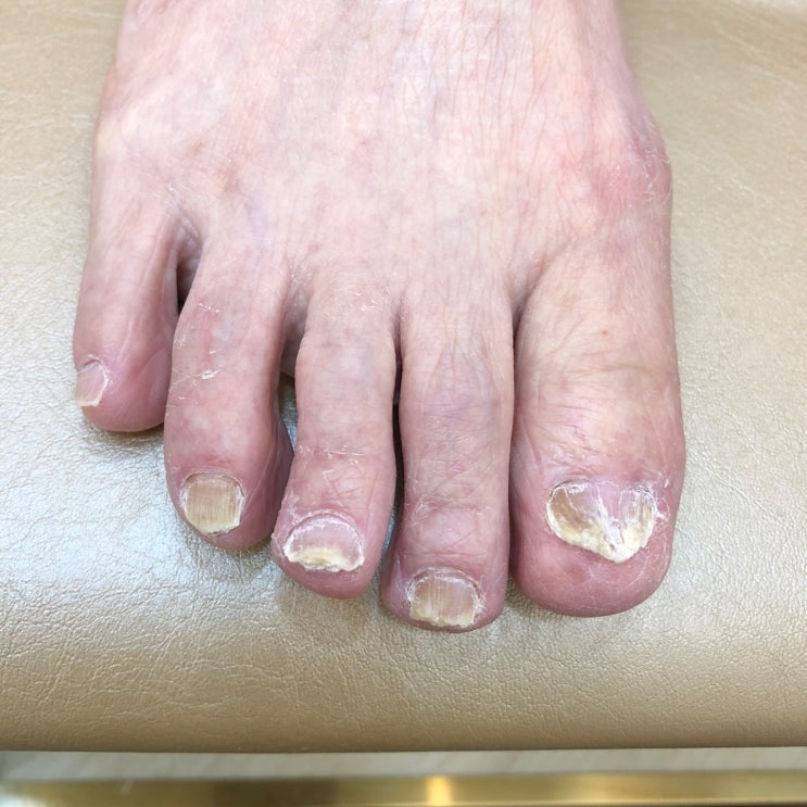  권선구 광교역 내성발톱, 무좀발톱, 발각질 리더스뷰티 다녀왔어요