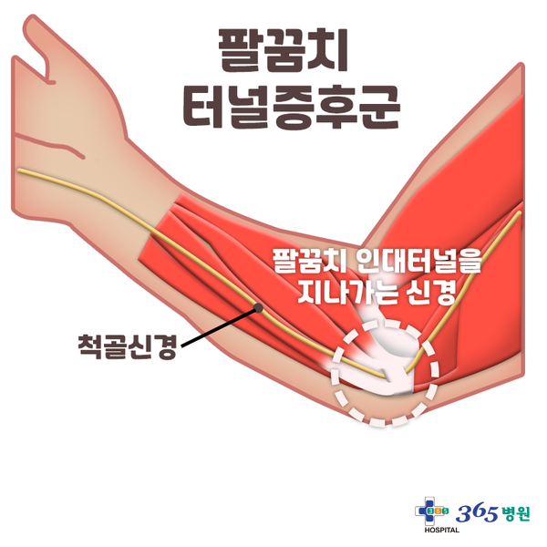  [창원마산 척추관절 디스크 365병원] 팔꿈치 터널 증후군(주관절 터널 증후군)
