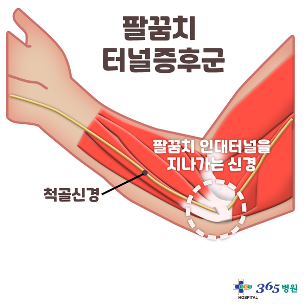 [창원마산 척추관절 디스크 365병원] 팔꿈치 터널 증후군(주관절 터널 증후군)