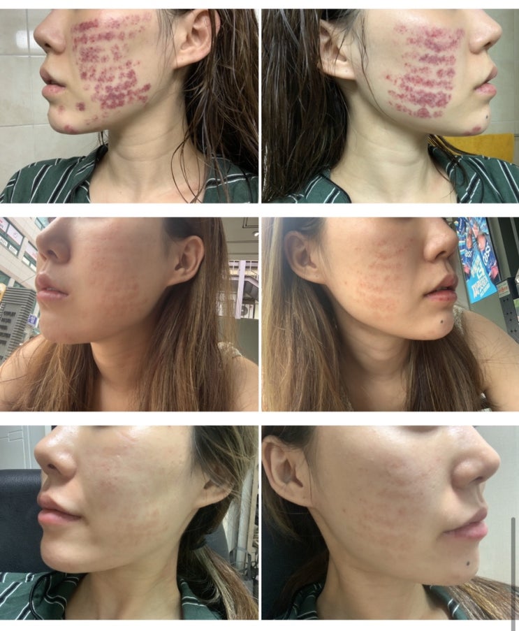  광화문피부과 시너지레이저 2회차 잡티제거, 색소침착 솔직후기