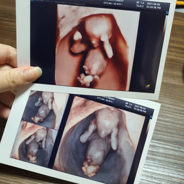  1차 기형아 검사와 임신 12주 부터의 증상 파악