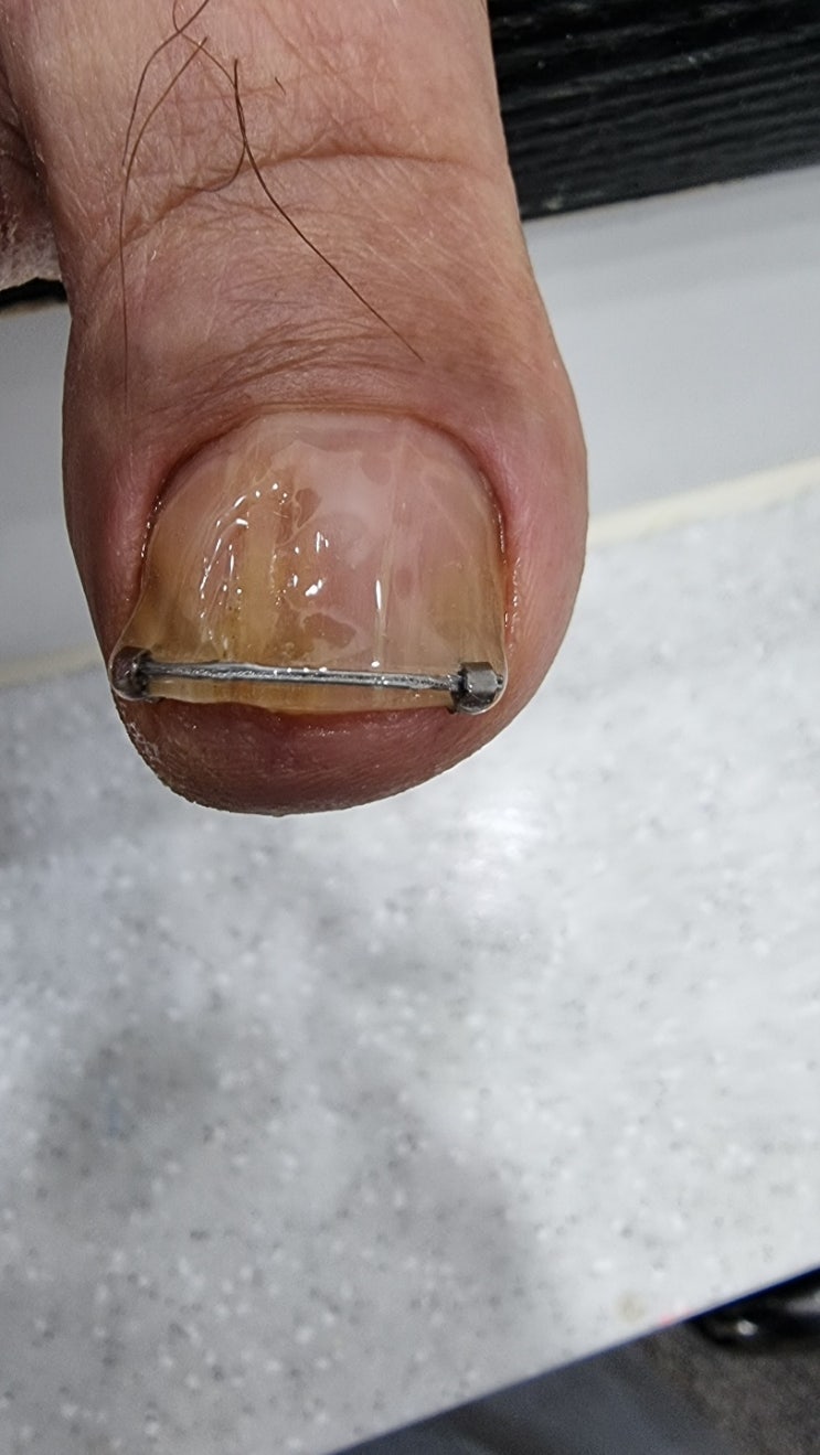  잠실 송파 무좀발톱, 발각질, 내성발톱 전문 네일샵 루덴네일!