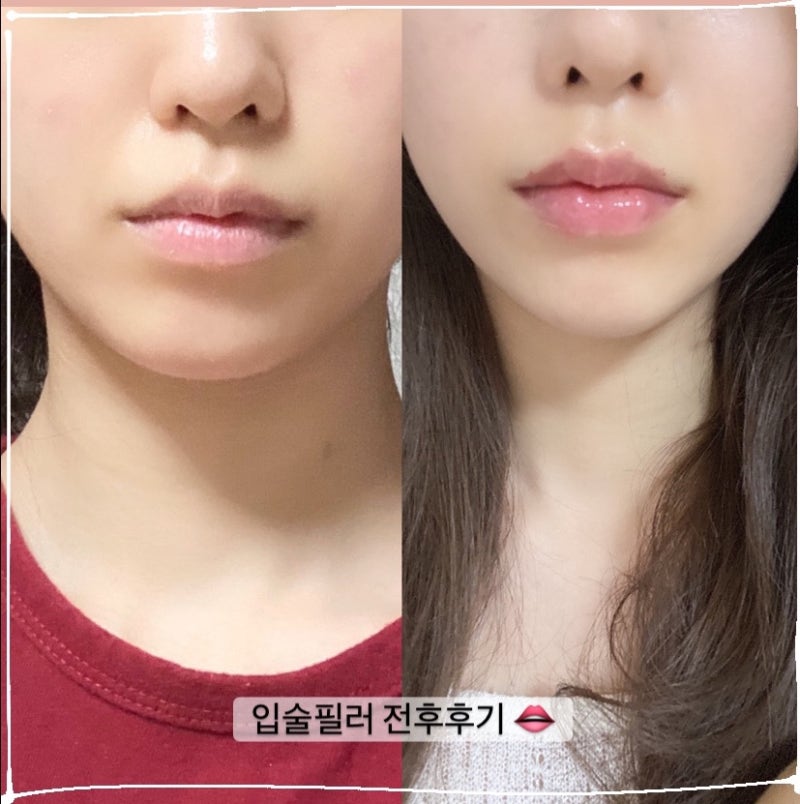 강남성형외과 | 필러 장인에게 받았던 입술필러 대만족 후기