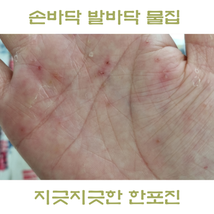  손가락 수포 손바닥 발바닥 한포진 원인, 물집 전염 가능성은?