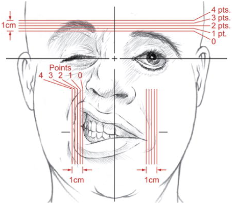 안면신경마비의 평가, 진단 facial nerve grading system