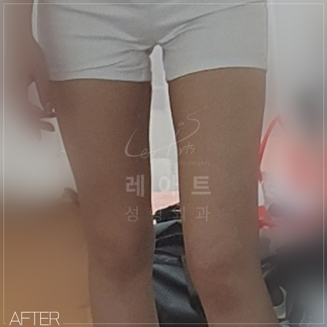  골반라인을 살리는 허벅지지방흡입