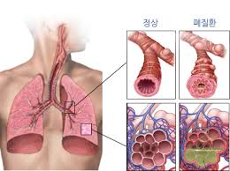 호흡기계공부 객담색깔 기침종류 청진촉진음 동맥혈가스분석ABGA 폐기능검사PFT 흉곽천자 결핵검사