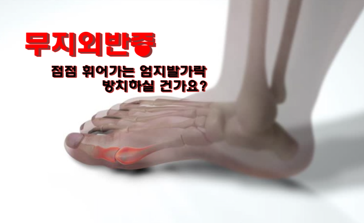  무지외반증 원인과 증상｜엄지발가락이 점점 휘어진다?