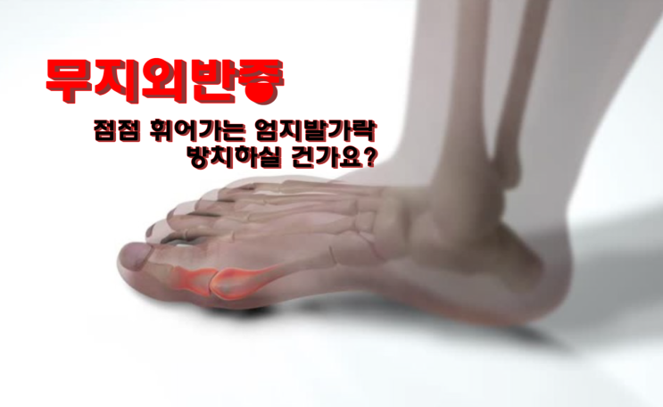 무지외반증 원인과 증상｜엄지발가락이 점점 휘어진다?