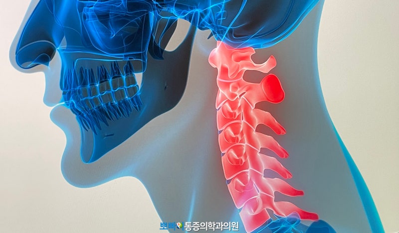 경추 5번 6번 7번 교정 운동 배우기! : 네이버 블로그