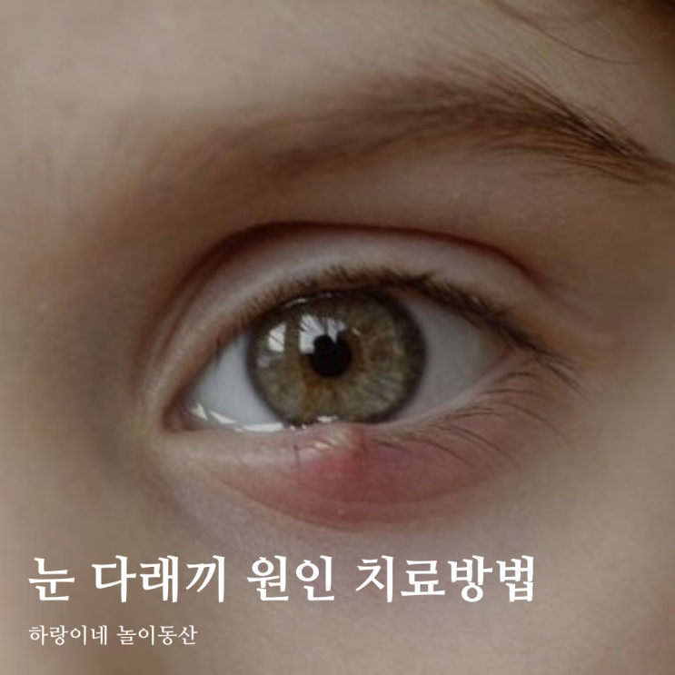  광주안과에 물어본 아기 눈 다래끼 원인과 치료방법