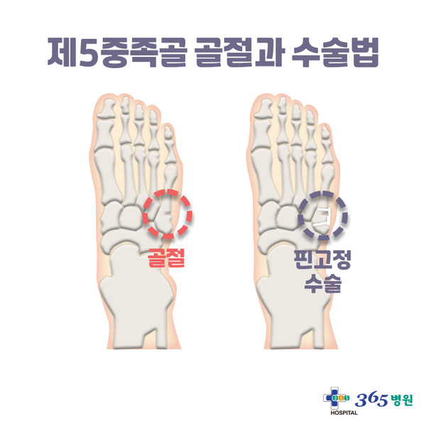  [창원마산 척추관절 디스크 365병원] 발 골절 - 제5중족골 골절