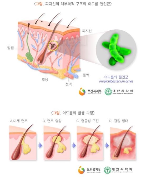 여드름 짜는 법 흉터 안 생기게 잘 짜는 방법! : 네이버 블로그