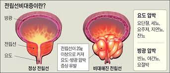  전립선비대증 초기치료예방 약물수술 경요도절제술 성욕감소 발기부전:쏘팔메토효능 중년남성