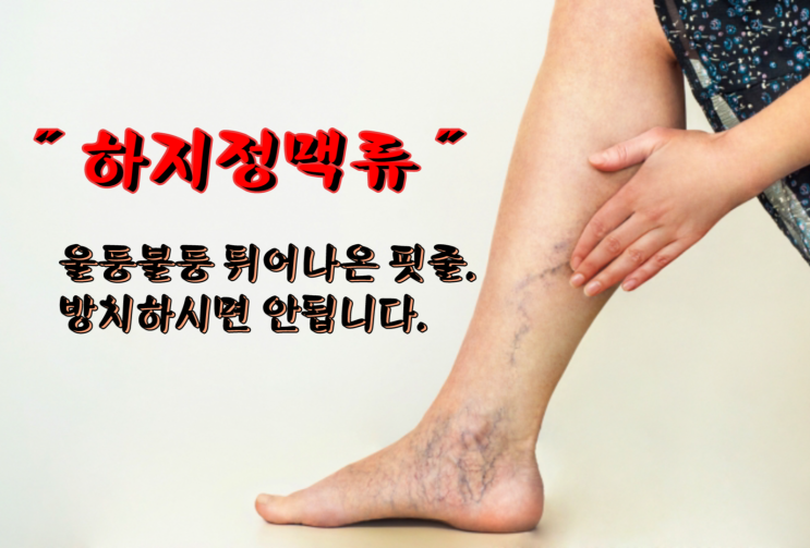  하지정맥류 원인과 증상, 치료법은?｜울퉁불퉁 튀어나온 핏줄!?