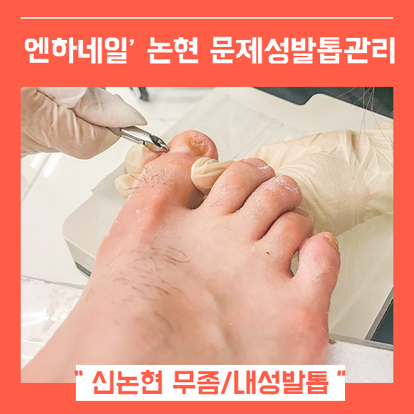  강남발톱무좀 제거 신논현 무좀발톱 (feat. 문제성발톱 엔하네일 )