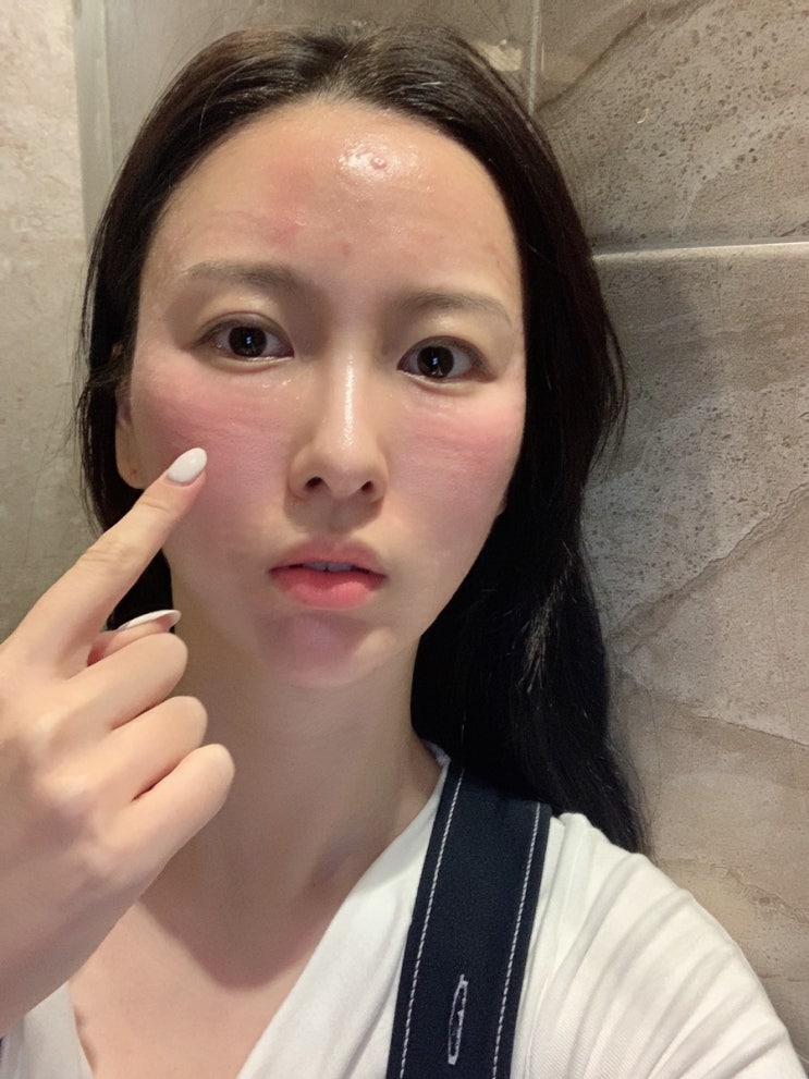  물광주사 스킨보톡스 부작용 너무 스트레스 받았어요ㅠㅠ