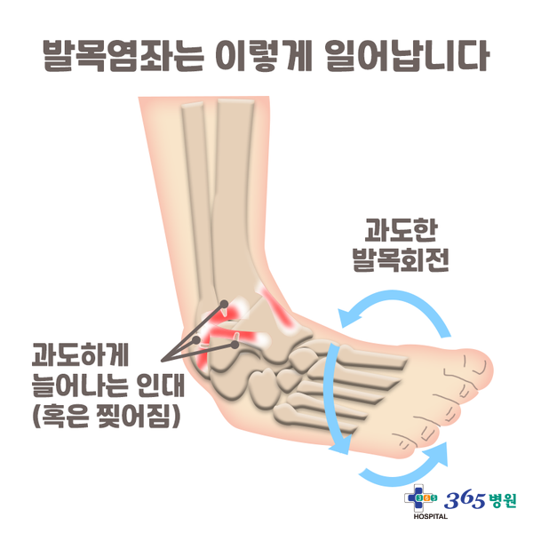 [창원마산 척추관절 디스크 365병원] 발 염좌 - 삐거나 접질림