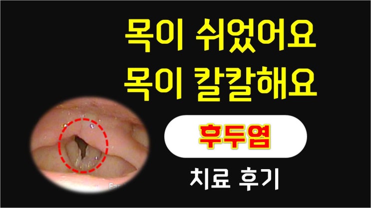  "목소리가 안나와요" 28세 연극배우 - 후두염 치료후기